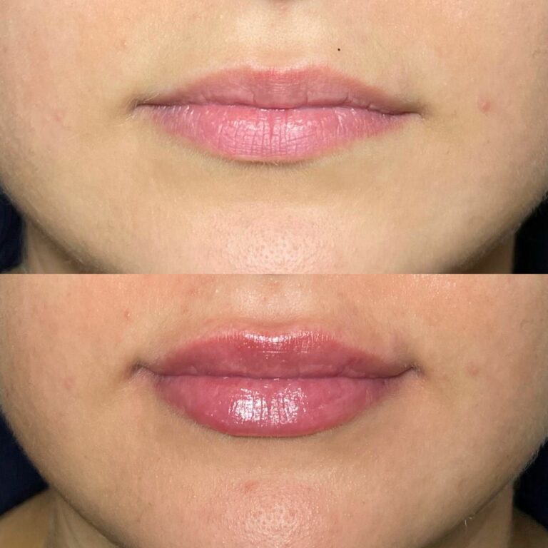 Lip Fillers, Botox, Dermal Fillers, Anti-Wrinkle Injections in Bounds Green N11